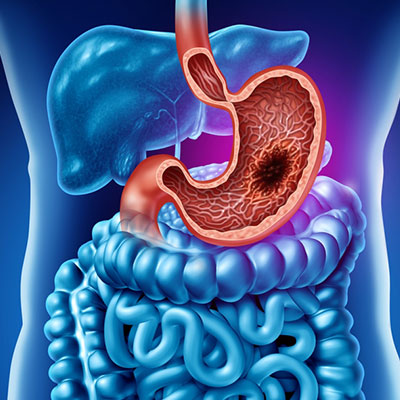 Gastrointestinal Cancers
